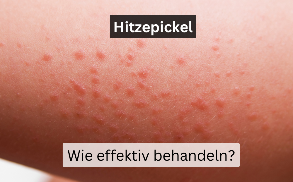 Hitzepickel